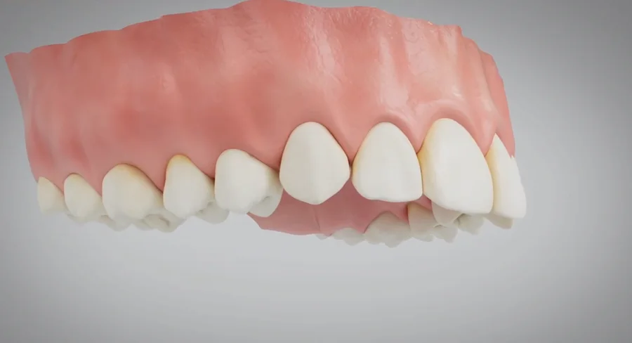 Resultado final: a coroa no lugar, harmônica com os dentes vizinhos